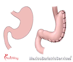 Slider image (2) Dr. Hector Perez Corzo Bariatric Surgery Mexico